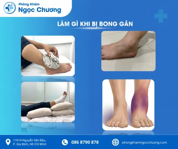 Xử Lý Bong Gân & Tổn Thương Dây Chằng: Hết Sưng Đau, Ngừa Tái Phát